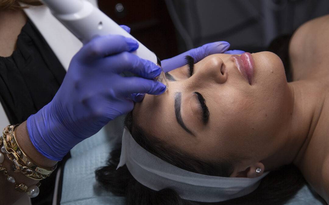 How long do Microneedling results last?