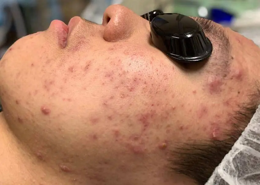 What is Adult Acne?