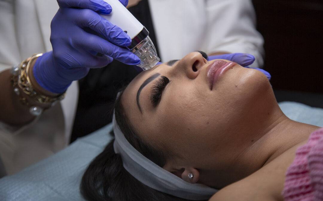 Best Benefits of Microneedling