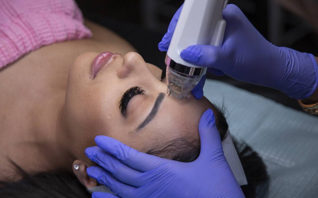 Harnessing the Power of Radiofrequency to Combat Acne