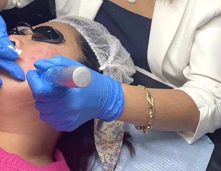 Face and Neck Microneedling Service