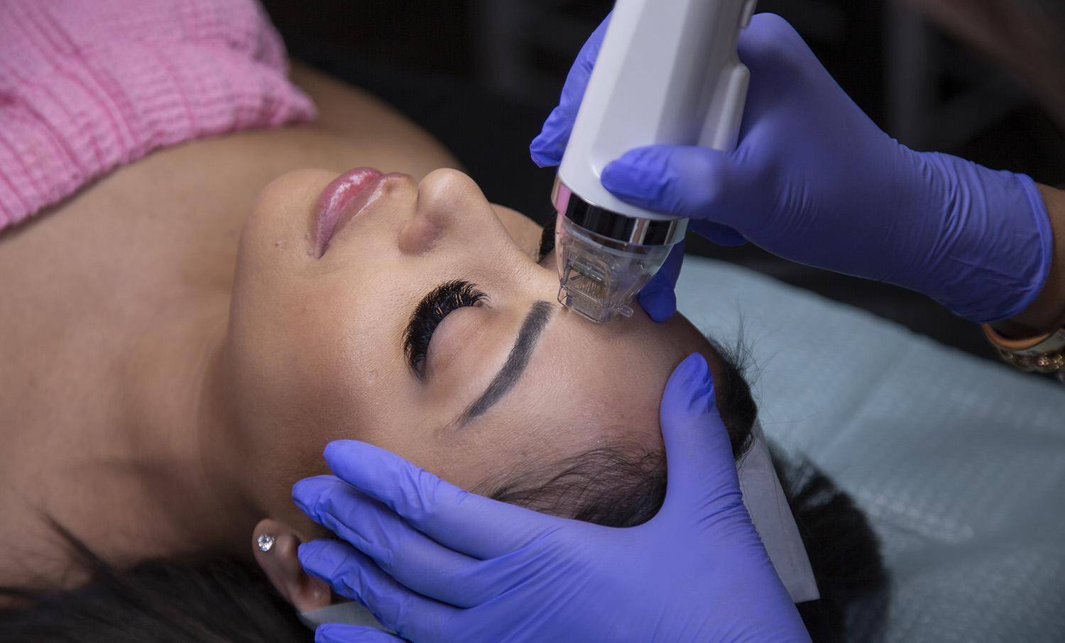 face and neck microneedling