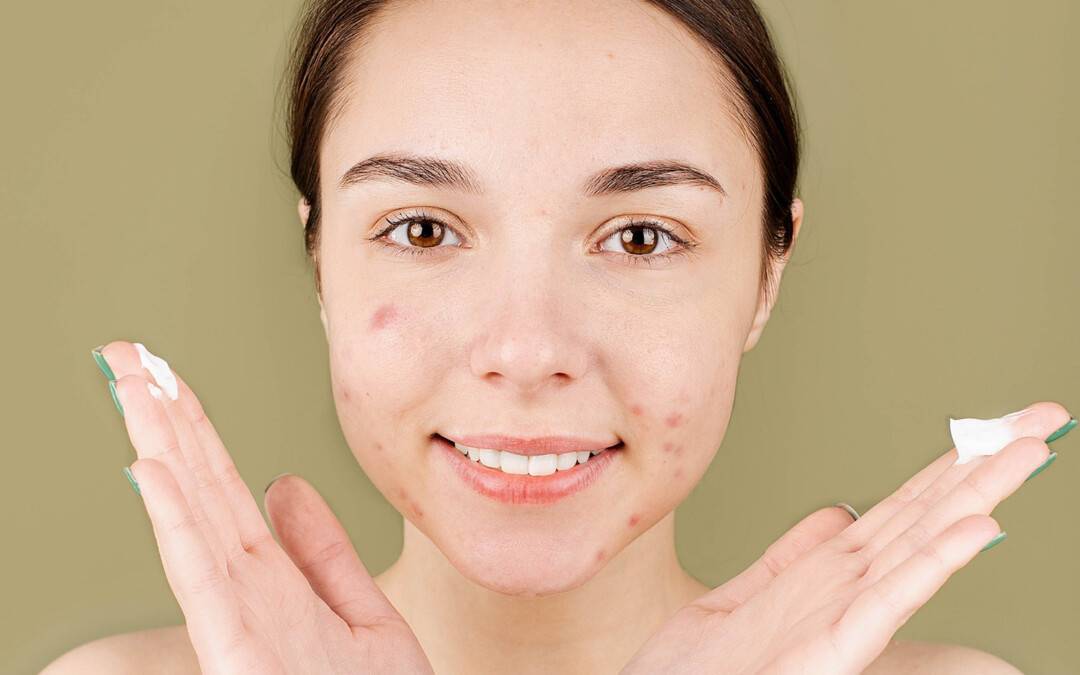 How to get rid of Acne Scars: Rediscover clear skin