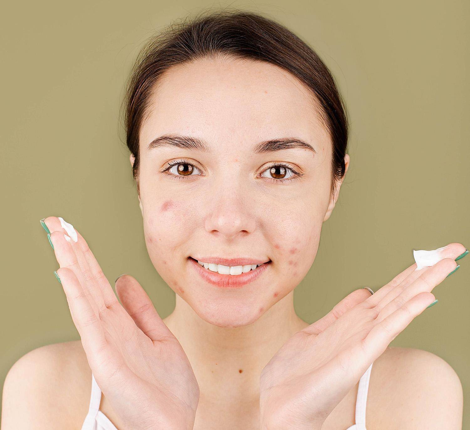 how to get rid of acne scars